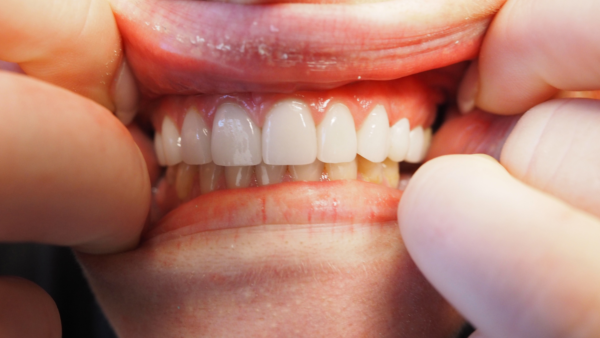 Westwood Dentist, Dentist Westwood, Dr. Philip Aurbach, Old hook Dental