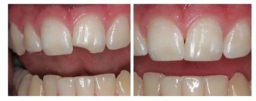 Westwood Dentist, Dentist Westwood, Dr. Philip Aurbach, Old hook Dental