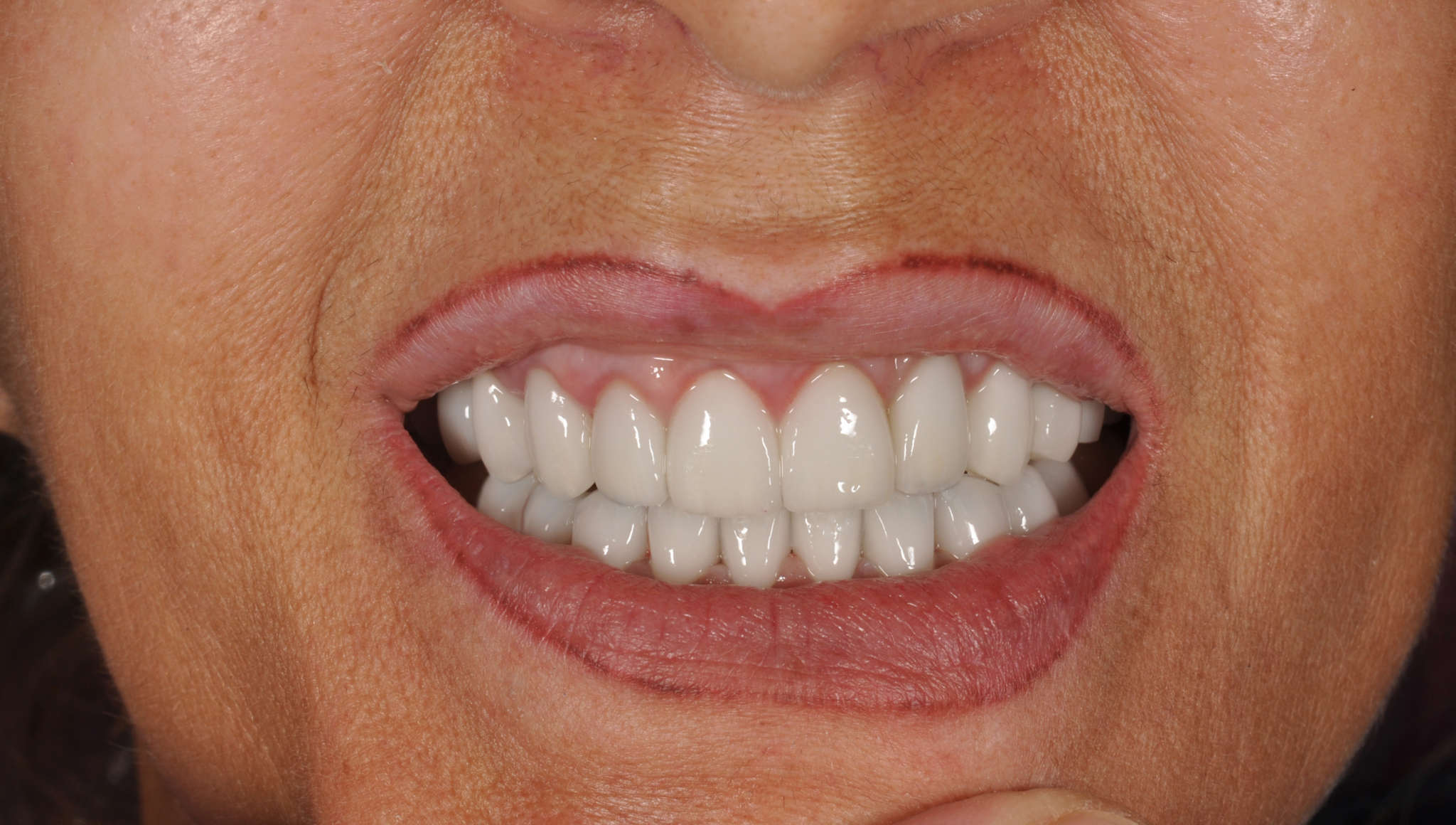 Full dental veneer and crown