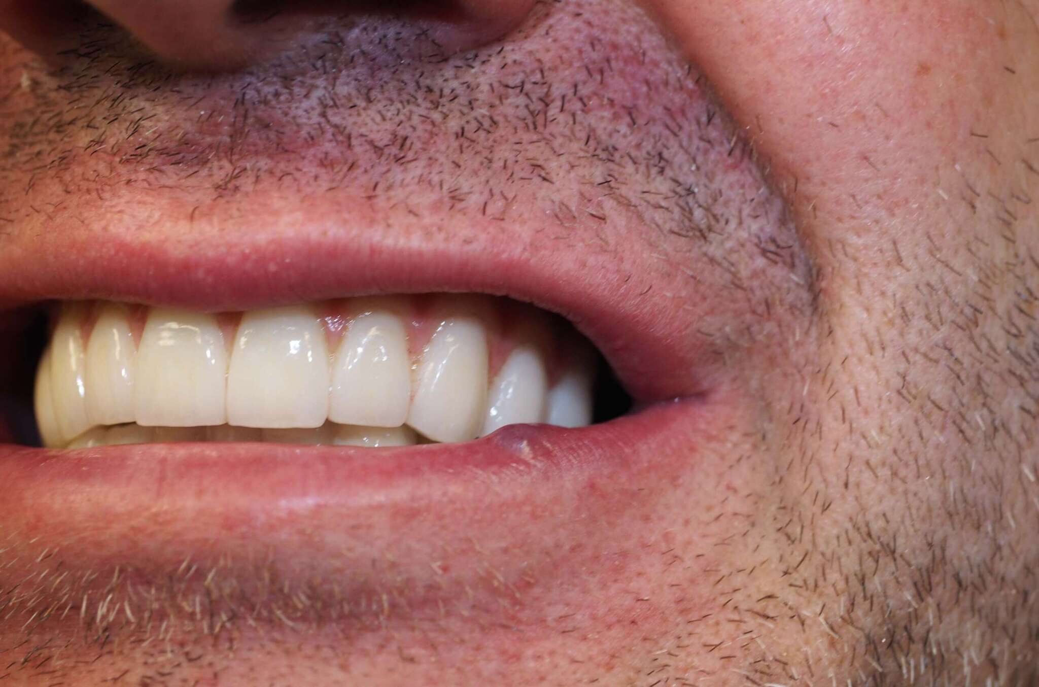 Dental Implant tooth Restoration