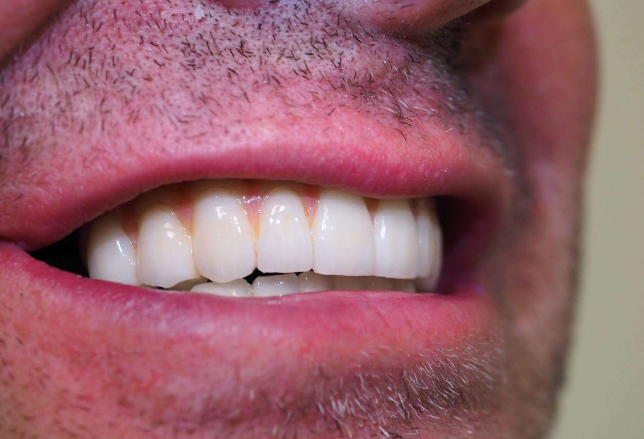 Dental Implant tooth Restoration