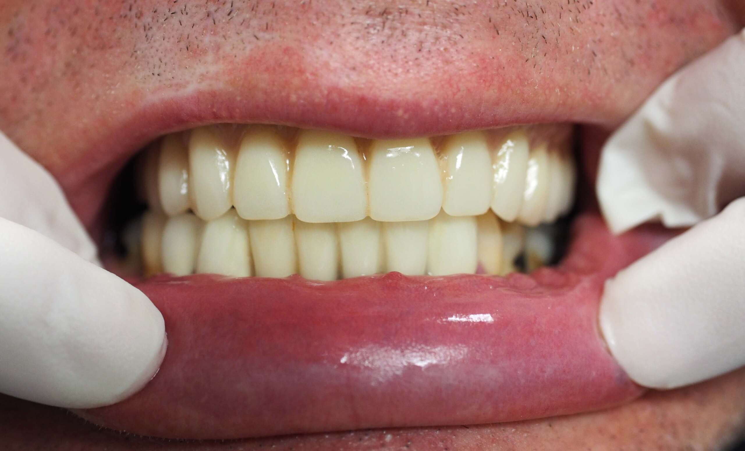 Dental Implant tooth Restoration