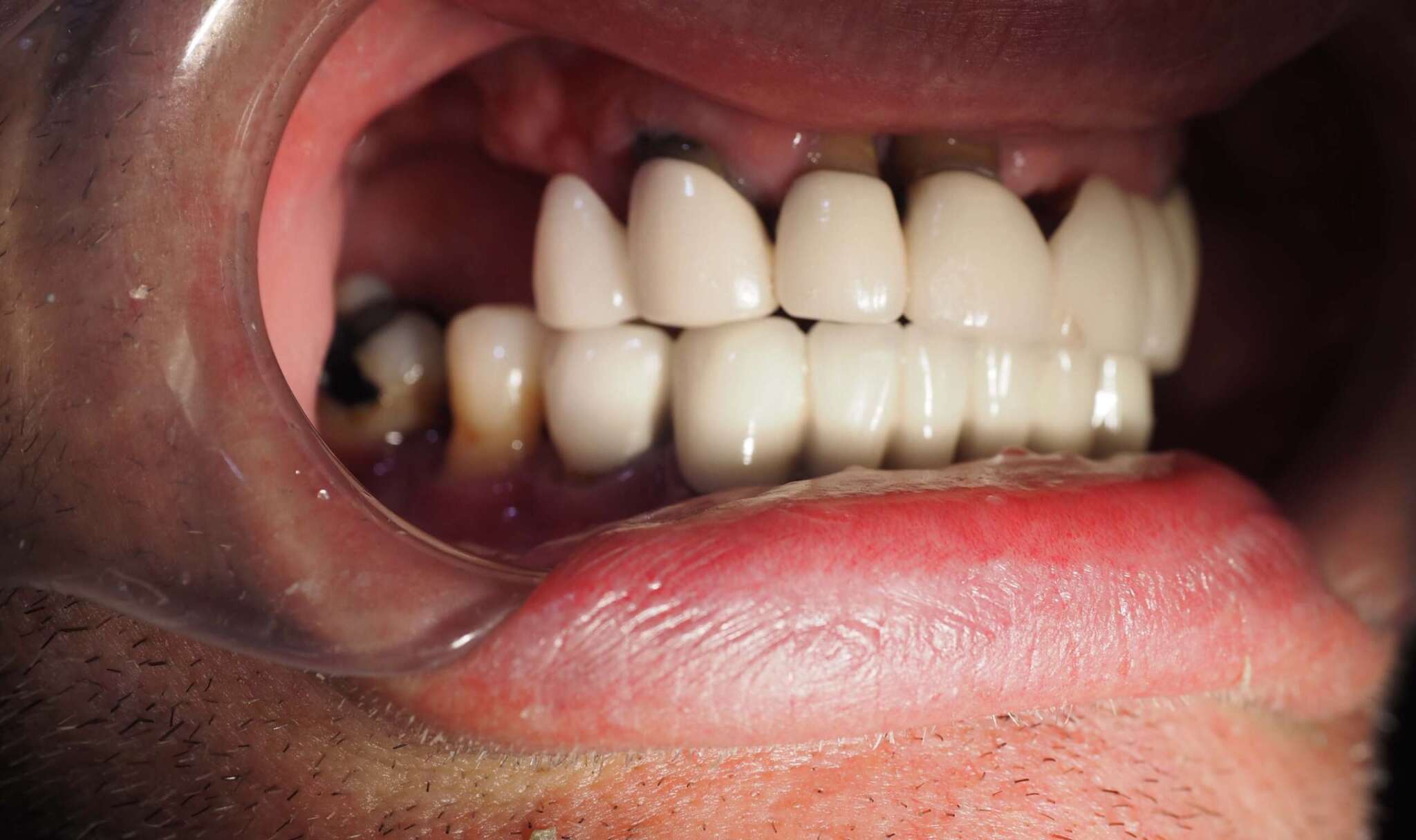 Dental Implant tooth Restoration