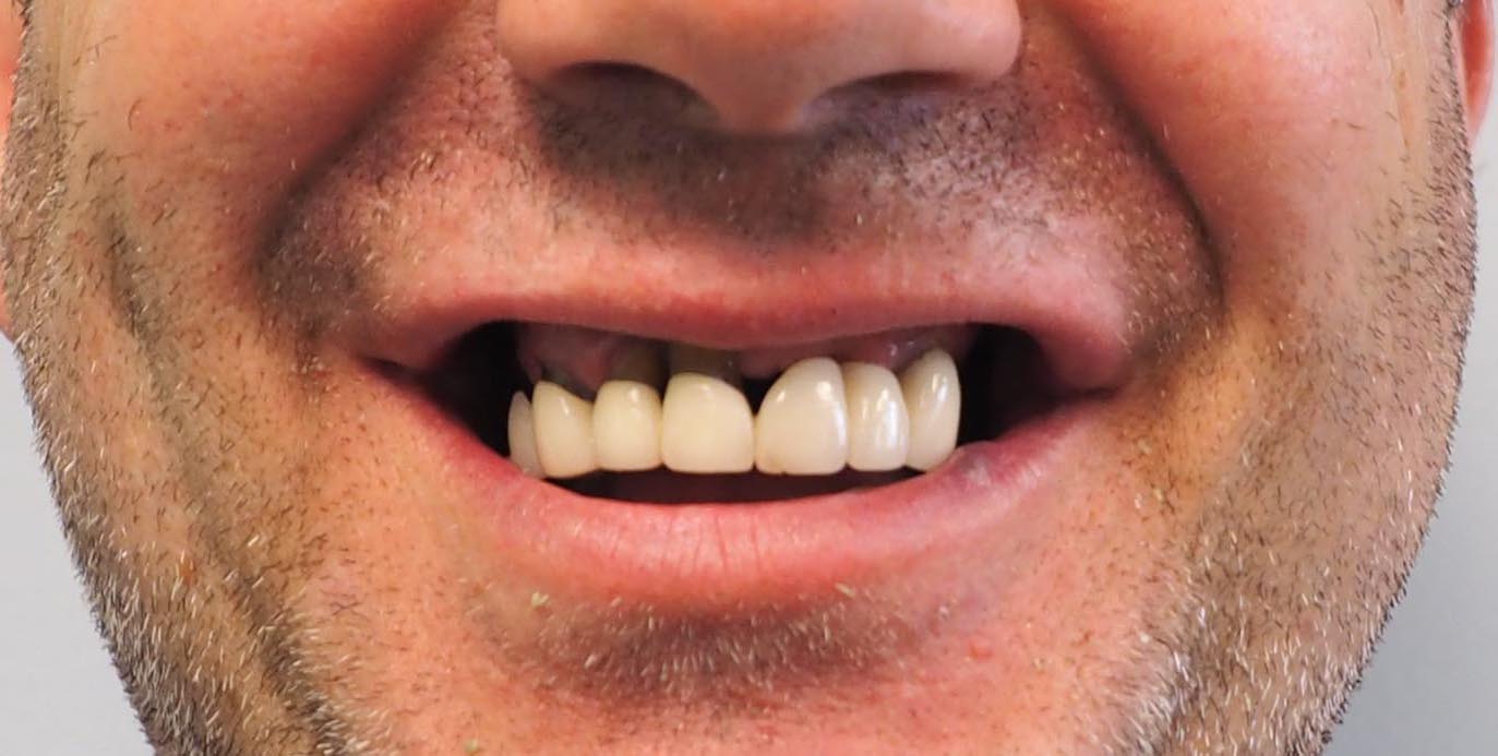 Dental Implant tooth Restoration